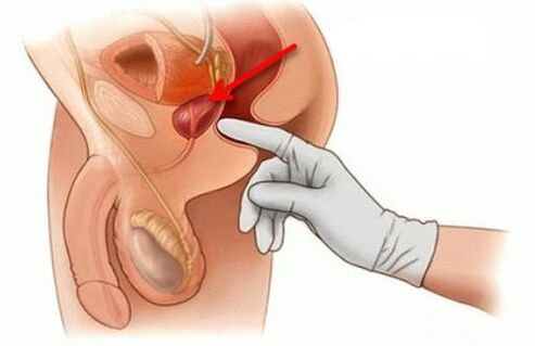масаж на простатата при простатит